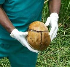 The skull of one of the murdered held by government pathologist Owizz Koroma. He has now confirmed that two people whose bodies were exhumed for examination died of gunshot wounds.